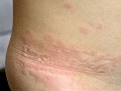 Аллергия на укусы постельных клопов